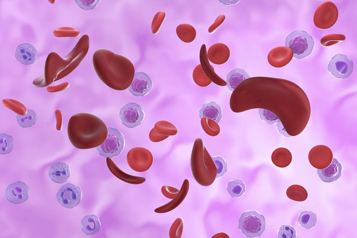 Red blood cells affected by sickle cell anaemia