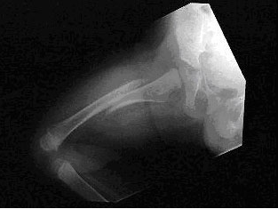 A radiograph of a femur showing a displaced transverse fracture of the shaft of the femur without soft tissue changes