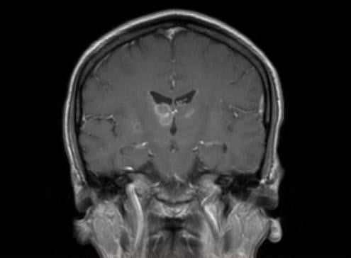 MRI of a patient with headaches, nausea and vomiting.