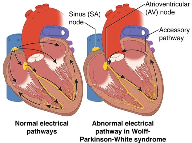 Palpitations USMLE article - Heart diagram