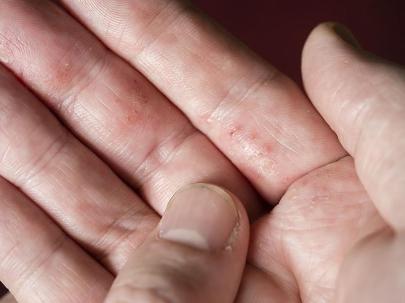 Small blisters on a hand