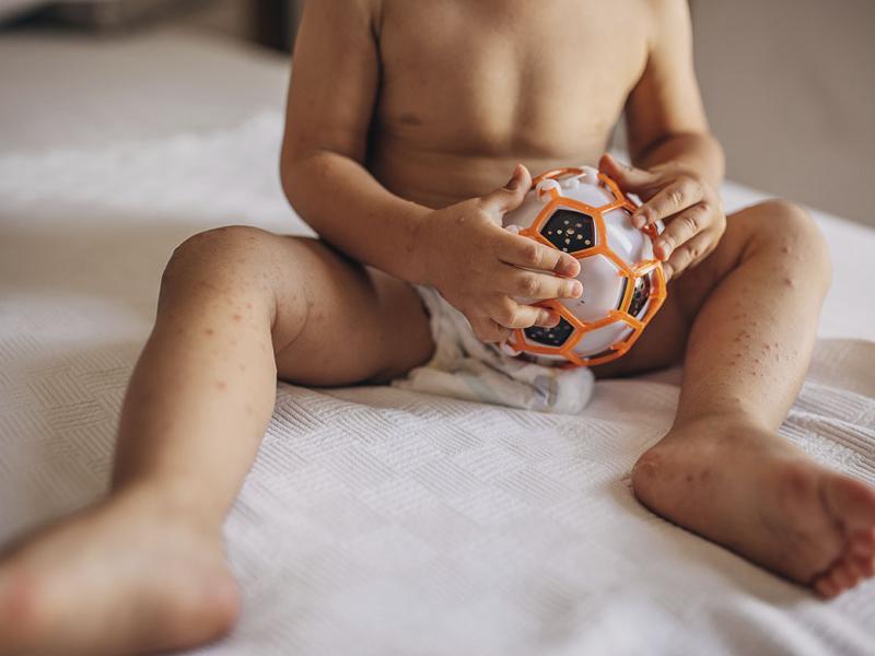 Child with with hand foot and mouth disease