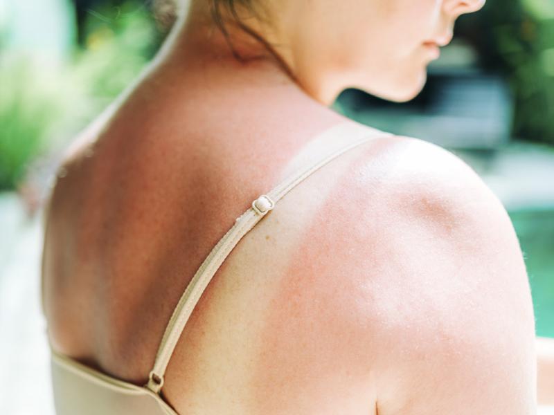 Woman with sunburn on back and shoulder