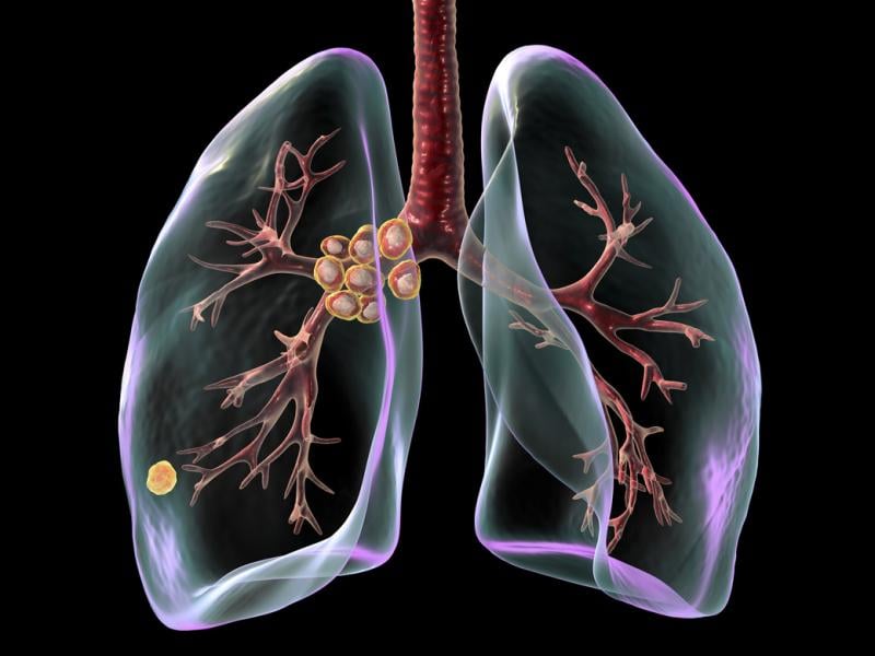  Primary lung tuberculosis