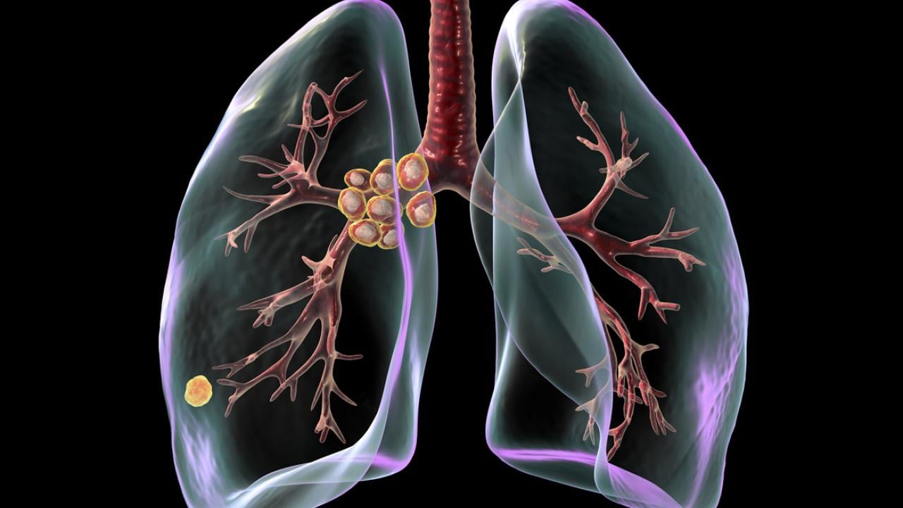 Ilustración médica de un nódulo pulmonar detectado en los bronquios