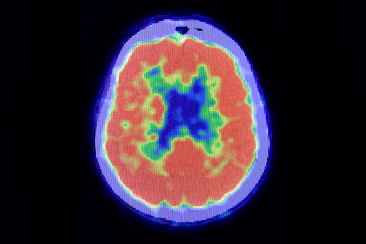 PET scan of human brain