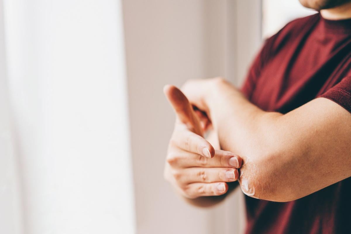 Person rubs lotion on elbow