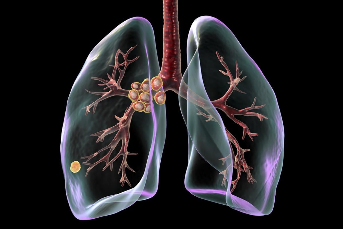  Primary lung tuberculosis