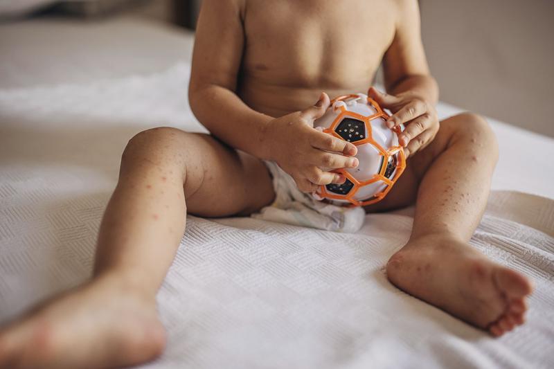 Child with with hand foot and mouth disease
